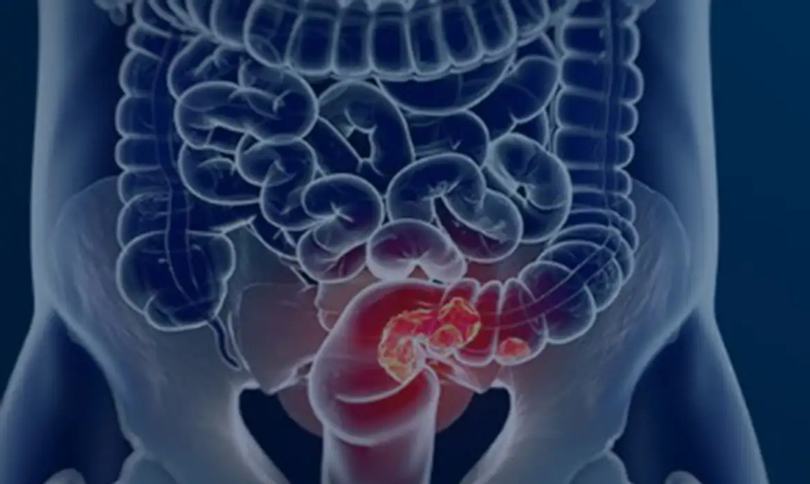 Pacientes com câncer colorretal são diagnosticados em estágio avançado 